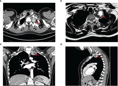 Case report: Combined cervical incision with an intercostal uniportal video-assisted thoracoscopic surgery approach for mediastinal brachial plexus schwannoma